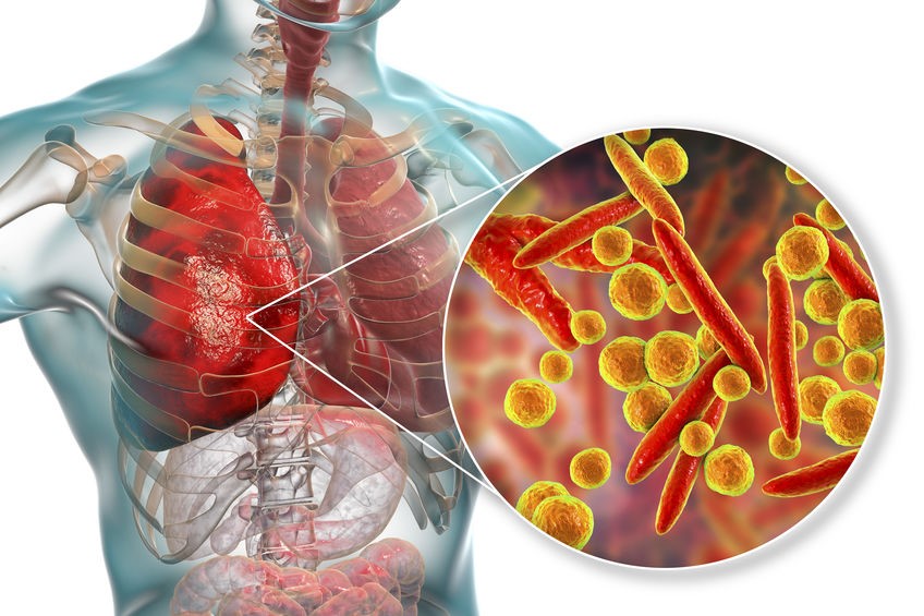 Những điều cần biết về bệnh viêm phổi do Mycoplasma Pneumonie (M.P)