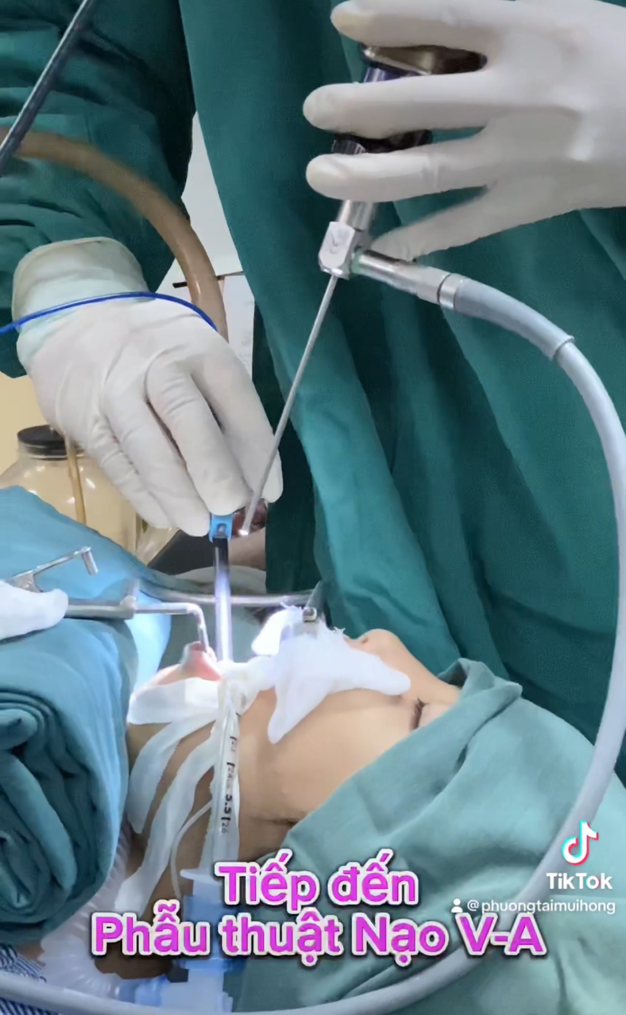 phẫu thuật điều trị 2 trong 1: nạo VA và cắt Amidan cho trẻ từ 3 tuổi với sự hỗ trợ chuyên môn của Bác sĩ chuyên gia Tai Mũi Họng đến từ Bệnh viện đầu ngành Tai Mũi Họng Việt nam – Cu Ba.